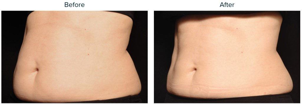 Coolsculpting