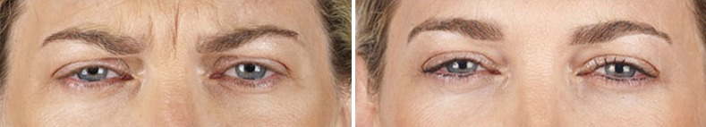 botox
